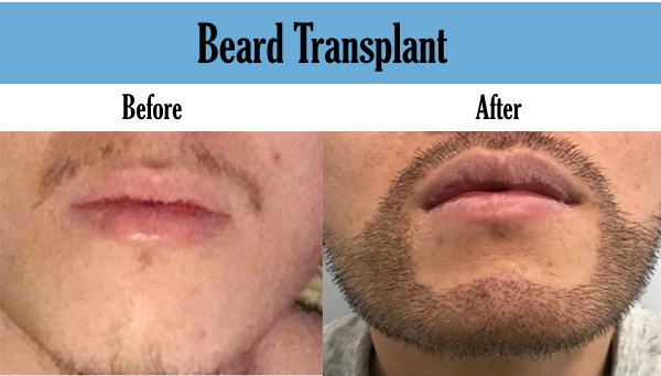 men hair transplant