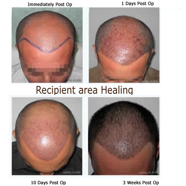 hair transplant recipient area healing
