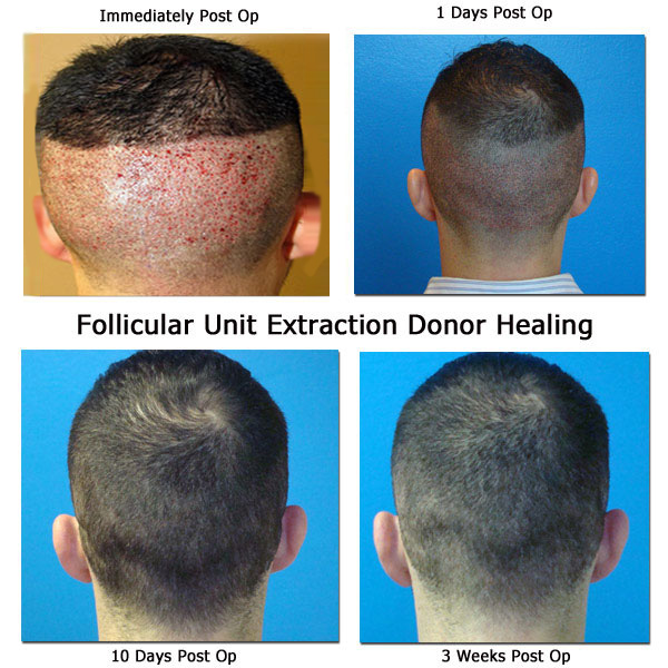hair transplant donor area healing