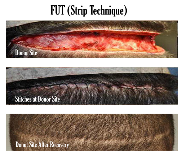 FUT hair Transplant