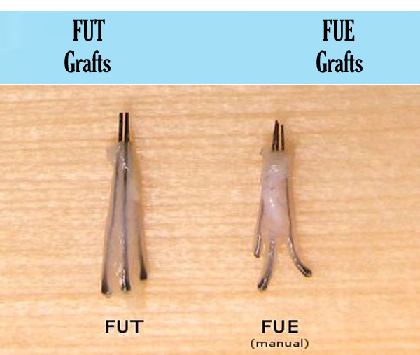 hair transplant donor area healing