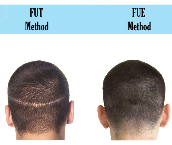 hair transplant donor area healing