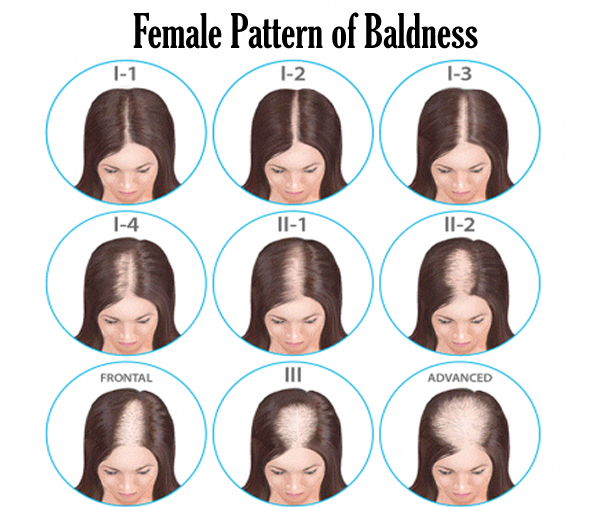 female Pattern of Baldness