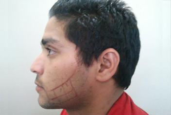 initial condition of patient in type 3 baldness