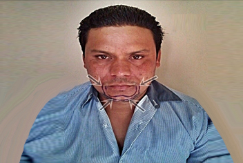 French beard hair transplant 1200 grafts