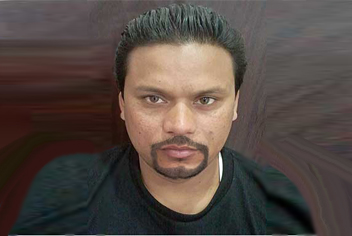 Beard hair Transplant of 1200 grafts