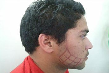 Hairline design on hair transplant recipient of patient in type 3 baldness