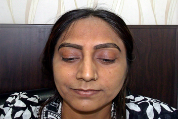 Hairline design on hair transplant recipient of patient in type 3 baldness