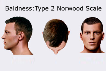 Hairline design on hair transplant recipient of patient in type 3 baldness