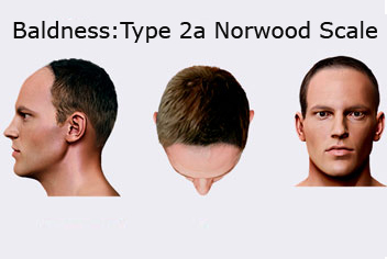 Hairline design on hair transplant recipient of patient in type 3 baldness