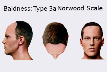 Norwood Scale type 3a Baldness