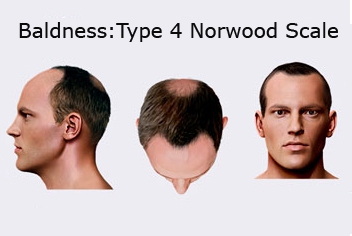 Hairline design on hair transplant recipient of patient in type 3 baldness