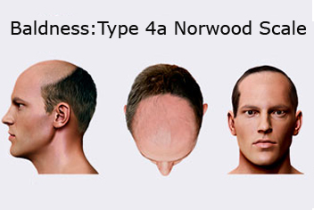 Hairline design on hair transplant recipient of patient in type 3 baldness