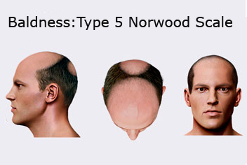 Hairline design on hair transplant recipient of patient in type 3 baldness