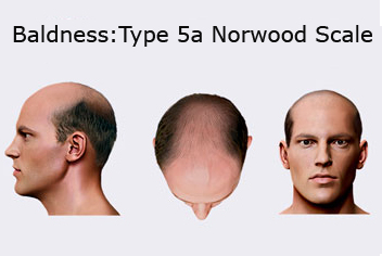 Hairline design on hair transplant recipient of patient in type 3 baldness