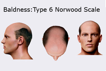Hairline design on hair transplant recipient of patient in type 3 baldness