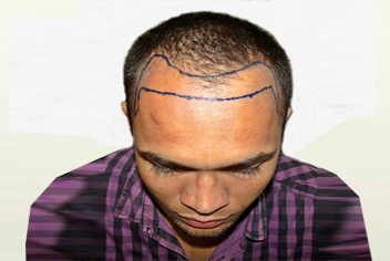 Hairline design on hair transplant recipient of patient in type 3a baldness