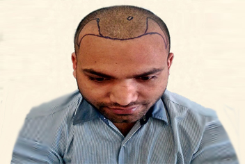 initial condition of patient in type 3 baldness