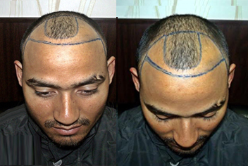 initial condition of patient in type 3 baldness