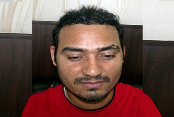 Hairline design on hair transplant recipient of patient in type 3 baldness