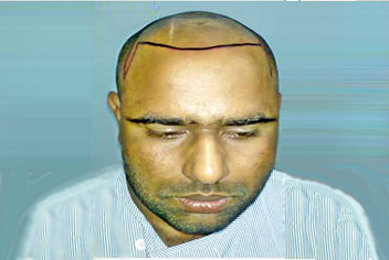 initial condition of patient in type 3 baldness