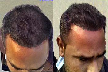Hairline design on hair transplant recipient of patient in type 3 baldness