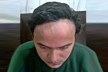 initial condition of patient in type 3 baldness