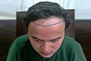 Hairline design on hair transplant recipient of patient in type 3 baldness