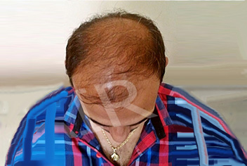 Hairline design on hair transplant recipient of patient in type 3 baldness