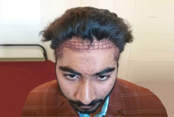 initial condition of patient in type 3 baldness