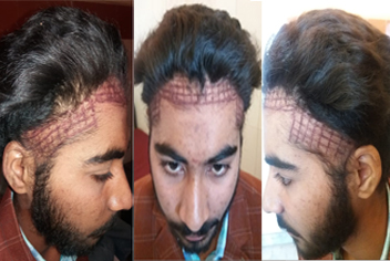 Hairline design on hair transplant recipient of patient in type 3 baldness