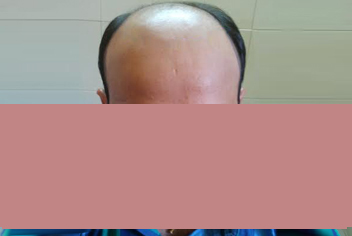 initial condition of patient in type 3 baldness