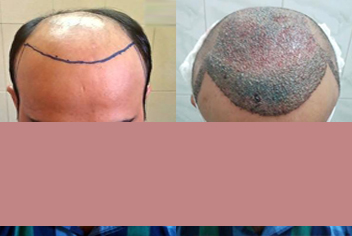 Hairline design on hair transplant recipient of patient in type 3 baldness