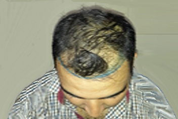 initial condition of patient in type 3 baldness