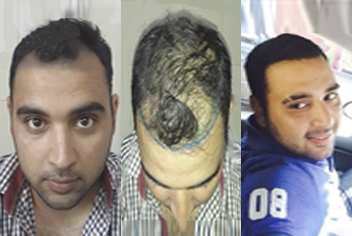 Hairline design on hair transplant recipient of patient in type 3 baldness