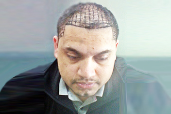 initial condition of patient in type 3 baldness