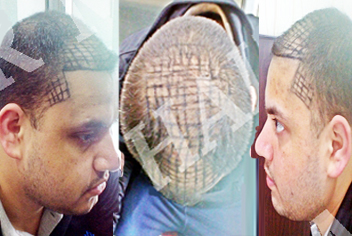 Hairline design on hair transplant recipient of patient in type 3 baldness