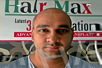 initial condition of patient in type 3 baldness