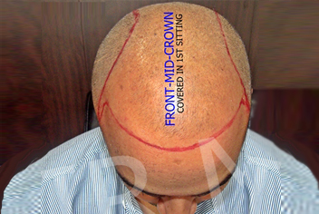 Hairline design on hair transplant recipient of patient in type 3 baldness