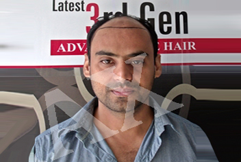 initial condition of patient in type 3 baldness