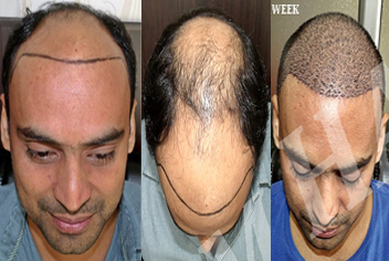 Hairline design on hair transplant recipient of patient in type 3 baldness