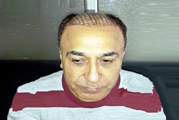 initial condition of patient in type 3 baldness