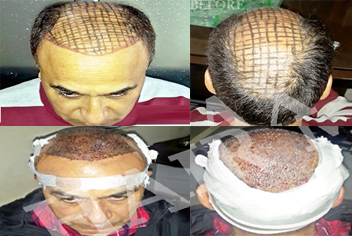 Hairline design on hair transplant recipient of patient in type 3 baldness