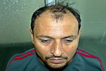 initial condition of patient in type 3 baldness