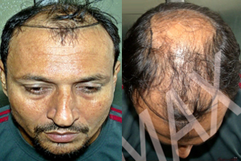 Hairline design on hair transplant recipient of patient in type 3 baldness