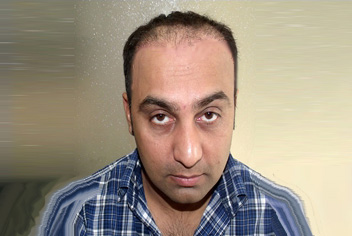 initial condition of patient in type 3 baldness