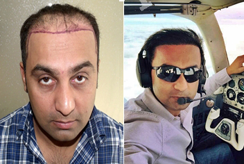 Hairline design on hair transplant recipient of patient in type 3 baldness