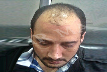 initial condition of patient in type 3 baldness