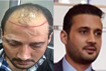 Hairline design on hair transplant recipient of patient in type 3 baldness