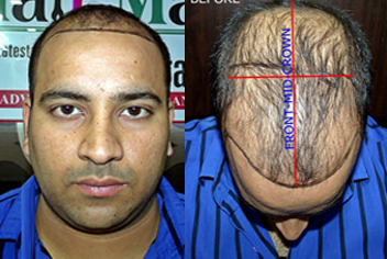 Hairline design on hair transplant recipient of patient in type 3 baldness